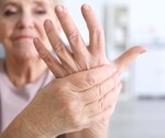 Is there a higher risk of depression among specific populations of patients with rheumatoid arthritis?