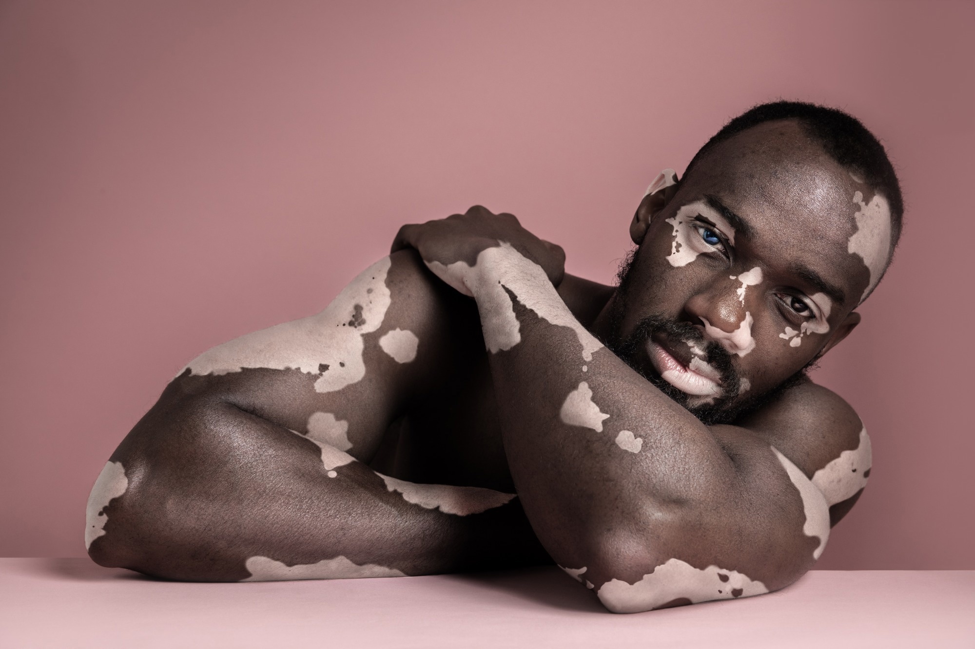 Study: Exploring the impact of diet and nutrition on vitiligo: A systematic review of dietary factors and nutritional interventions. Image Credit: Master1305 / Shutterstock