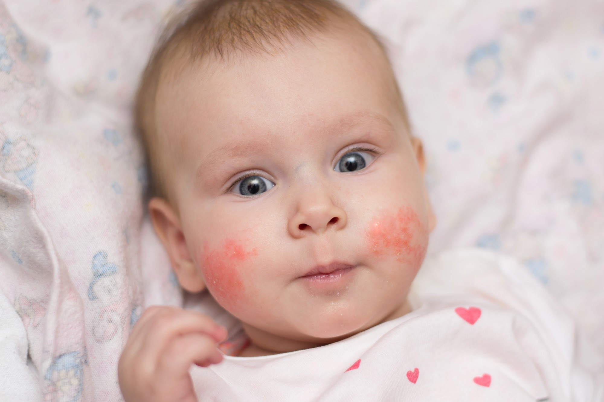 Study: Vitamin D level is inversely related to allergen sensitization for risking atopic dermatitis in early childhood. Image Credit: alexeisido / Shutterstock
