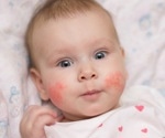 Low vitamin D in children linked to higher atopic dermatitis risk, study finds