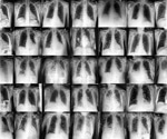 Can synthetic data boost fairness in medical imaging AI?
