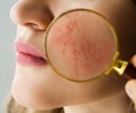 Study reveals significant link between rosacea and malignant melanoma