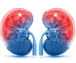 Improved kidney transplant success from deceased donors with dialysis history