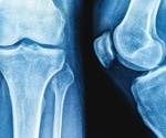 Study reveals exercise and GLP-1 RA combination preserves bone health during weight loss