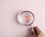 PCOS linked to higher risk of adverse birth outcomes
