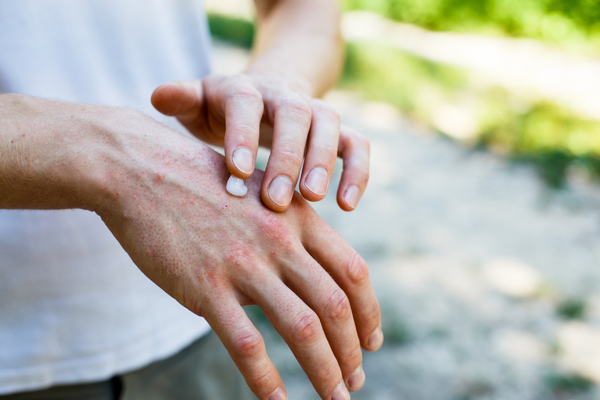 Study: Exposure to Air Pollution, Genetic Susceptibility, and Psoriasis Risk in the UK. Image Credit: Ternavskaia Olga Alibec / Shutterstock
