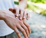 Long-term air pollution exposure doubles psoriasis risk, study finds