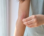 Study suggests limiting oral corticosteroid use to 90 days reduces adverse effects in atopic dermatitis patients