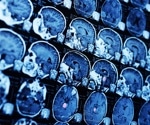 Depression has a consistent mark in the brain even when symptoms are absent
