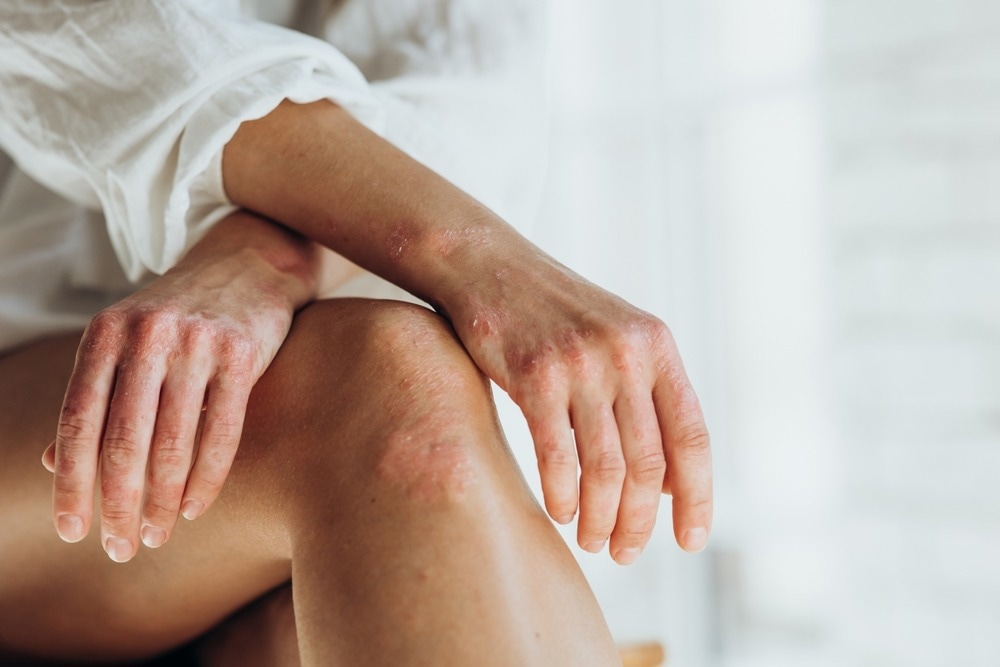 Study: Exploring the Link Between Genetic Predictors of Cardiovascular Disease and Psoriasis. Image Credit: Nina Buday/Shutterstock.com