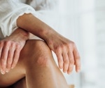 Cardiovascular disease pathways associated with psoriasis, but not other immune-mediated diseases