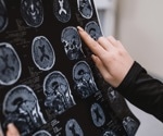 Stroke remains a leading cause of death globally, with increased risk linked to lifestyle factors