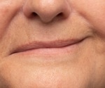 Research links COVID-19 vaccines to temporary facial palsy in over 5,000 patients