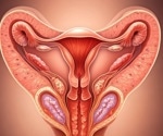 Understanding cardiovascular risks in endometriosis patients