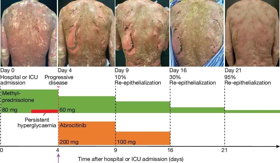 Disease course in a patient with TEN (SCORTEN 4) associated with cancer treatment. Disease progression was observed during high-dose intravenous methylprednisolone treatment and the patient developed persistent hyperglycaemia. JAK1i rescue therapy with abrocitinib was initiated on day 4, resulting in visible cessation of progression within 48 h and initial re-epithelialization within 4 days. Top, photographs of the back of the patient, showing the degree of re-epithelialization at the indicated timepoints after hospital admission. Bottom, Treatment schedule. Arrow marks start of abrocitinib treatment. Study: Spatial proteomics identifies JAKi as treatment for a lethal skin disease