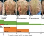 Researchers uncover the potential of JAK inhibitors to treat life-threatening skin disease