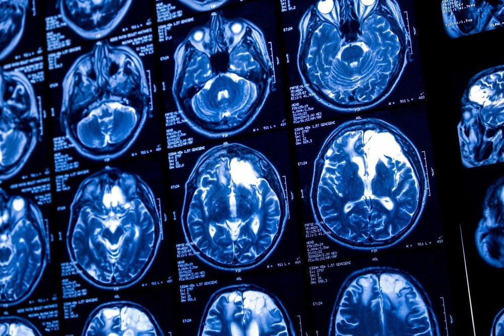 Study: Home-based transcranial direct current stimulation treatment for major depressive disorder: a fully remote phase 2 randomized sham-controlled trial. Image Credit: Elif Bayraktar/Shutterstock.com