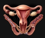Higher zinc intake linked to increased endometriosis risk, study finds
