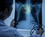 Quabodepistat combo shows promise for safer, faster tuberculosis treatment