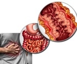 Filgotinib offers new promise for managing Crohn’s disease