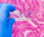 Machine learning reveals why cancer trials fall short in real-world patients