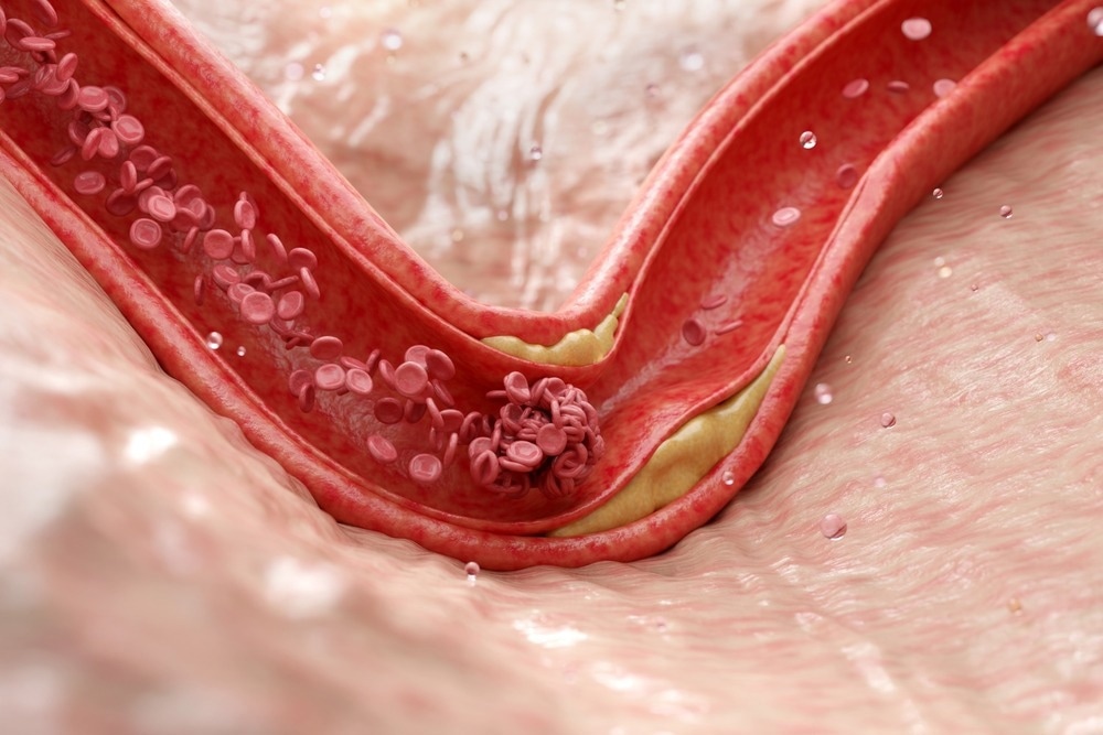 3D rendering of arteries narrowed by plaque buildup