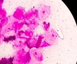 New study links cervicovaginal microbiome to increased risk of Chlamydia infections