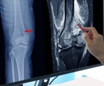 Strong heart, strong bones: How cardiovascular health influences bone density