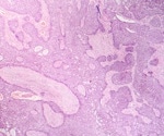 Cancer-fighting virus T-VEC helps shrink tough-to-treat skin tumors
