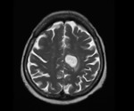 Firefighting chemicals leave brain cancer-linked mutations, study shows