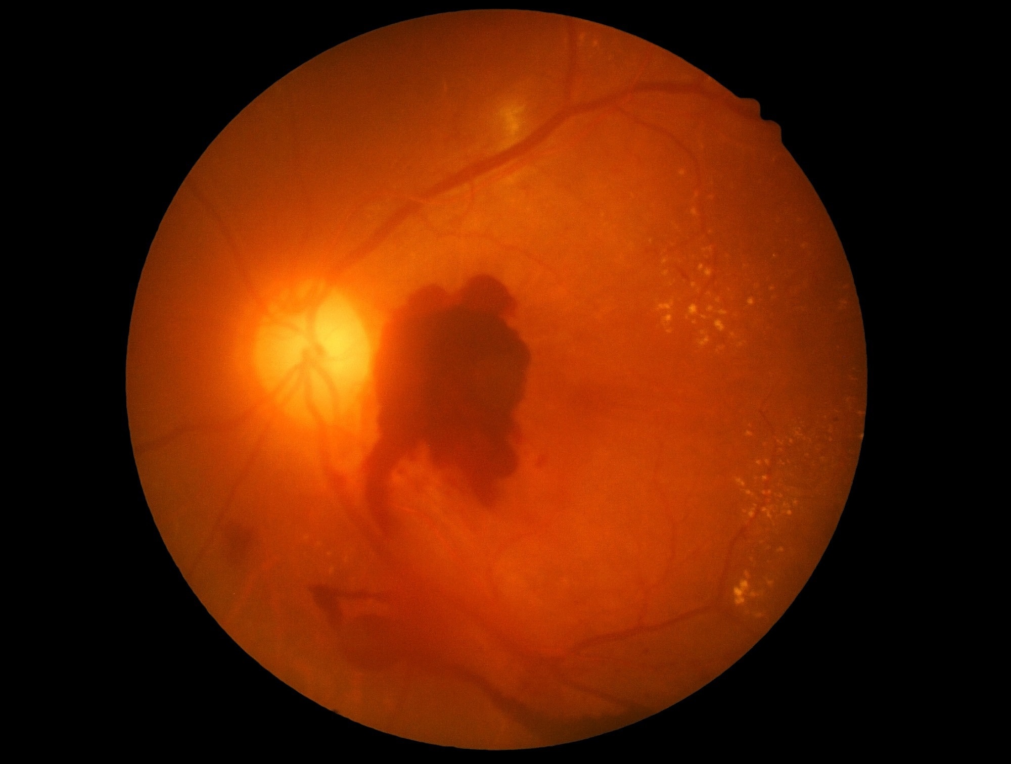 Study: Increased vision impairment reports linked to semaglutide: analysis of FDA adverse event data. Image Credit: memorisz / Shutterstock