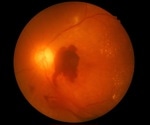 Semaglutide linked to higher risk of vision problems, FDA data analysis shows