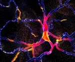 Blood test detects Parkinson’s years before symptoms appear using RNA markers