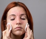 Why skin shame matters more than symptoms in chronic skin conditions