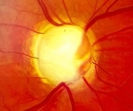 How urine caffeine levels may help detect diabetic eye damage early