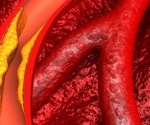 Obicetrapib slashes LDL cholesterol by over 30% in high-risk heart patients