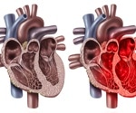 US hospitals see rising complications in patients with takotsubo cardiomyopathy