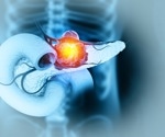 Large global study links higher alcohol intake to increased pancreatic cancer risk