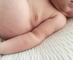 Japanese study shows c-sections do not raise allergy risk in children