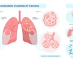 AI-designed drug shows early promise for lung fibrosis patients in clinical trial