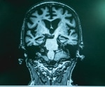 Could a diabetes drug be the key to stopping Alzheimer’s?