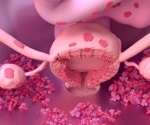 Endometriosis linked to higher odds of autoimmune conditions