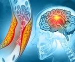 Blocking GAPDH aggregation protects brain cells and opens new path for stroke therapy