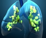 AI reshapes ARDS care by predicting risk, guiding ventilation, and personalizing treatment