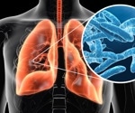 New Swiss study probes lingering fatigue after Legionnaires' disease