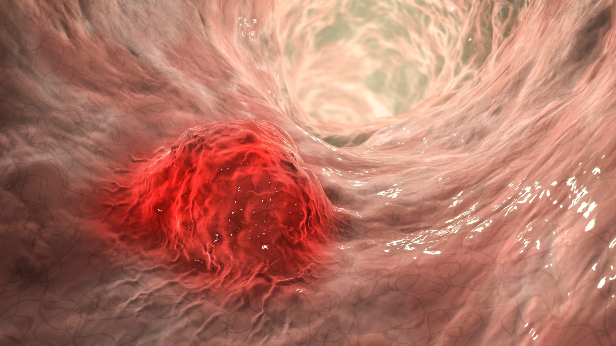 3D illustration showing malignant tumor in intestine