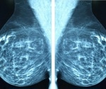 New therapeutic approach targets undruggable protein driving aggressive breast cancer