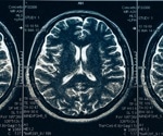 Study provides a new target for therapeutic intervention in Parkinson's disease
