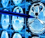 Understanding brain activity during sleep to detect early neurological changes