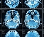 Prefrontal cortex RNA drives female-specific brain resilience to depression